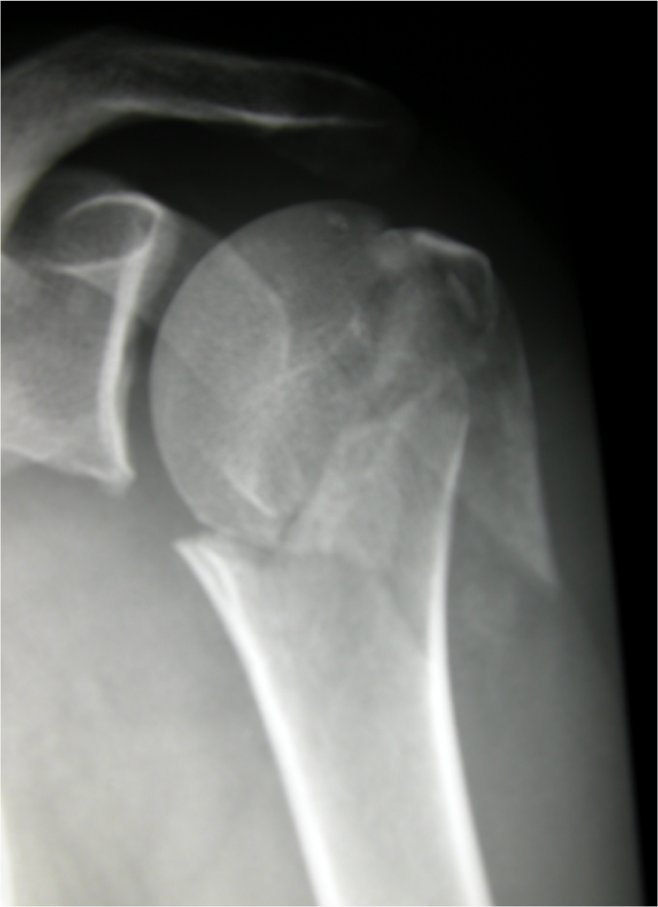 proximal humerus fracture