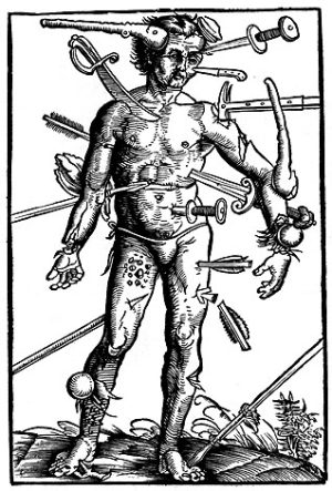 Иллюстрация, показывающая многообразие ранений из книги Feldbuch der Wundarznei (Полевое руководство по обработке ран) Ганса фон Герсдорфа (Hans von Gersdorff), (1517)