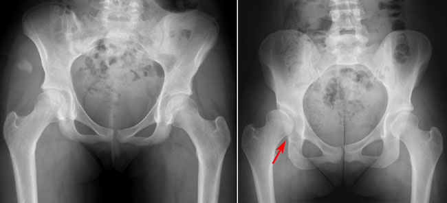 Изображение - Дисплазия тазобедренных суставов у детей рентгеновский снимок hip-displasia