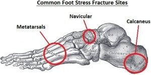 foot-stress-fractures300opt.jpg.pagespeed.ce.yhfJ5WfVqD