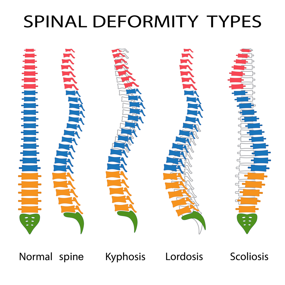 Spinal deformity types.